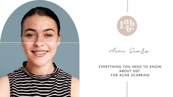 Everything You Need to Know About SQT  for Acne Scarring