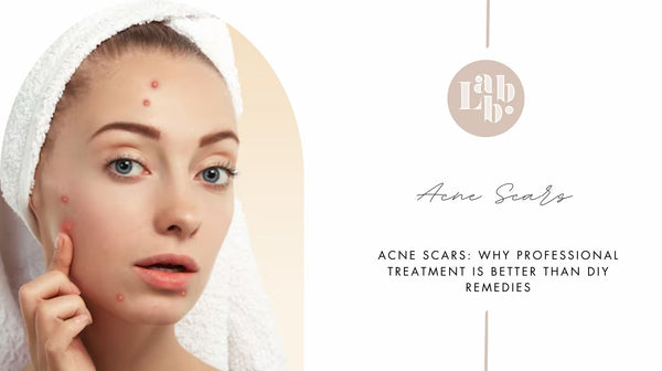 Acne Scars: Why Professional Treatment is Better Than DIY Remedies